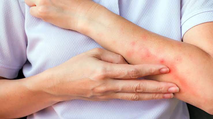 گزیدگی پشه Mosquito bite چینود chinod